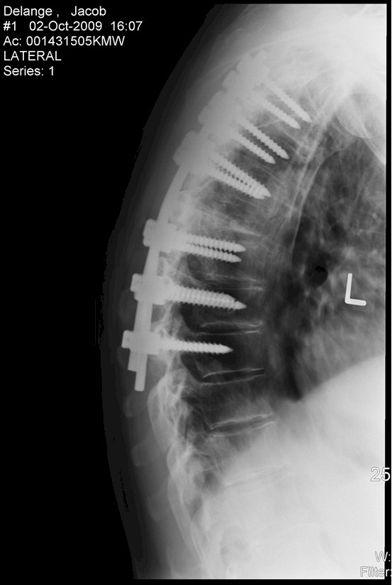Lateral Image of Jacob's repaired spine